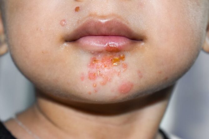 Μολυσματικό Κηρίο: Αίτια, Συμπτώματα & Θεραπεία